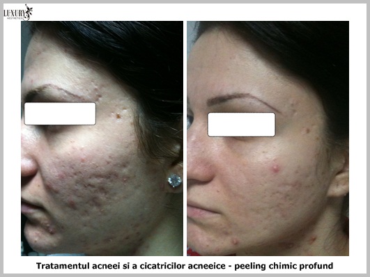 Pro și contra tratamentului cu laser pentru acnee - Modă - 