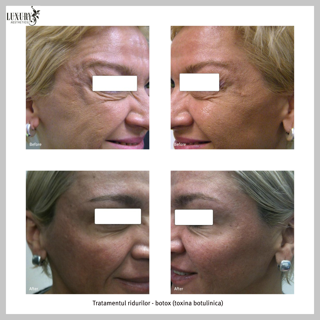 Chirurgie Faciala - Tratament Riduri, Scapa de Riduri - by Dr. Calu