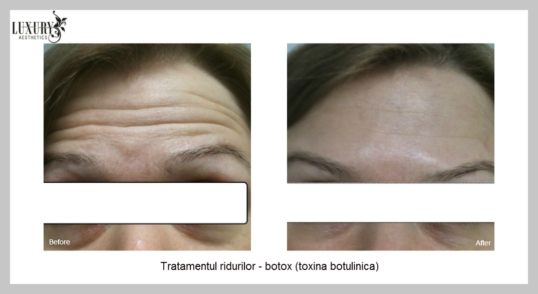 Tratament Botox pentru intindere riduri